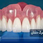 پروتز متحرک دندان