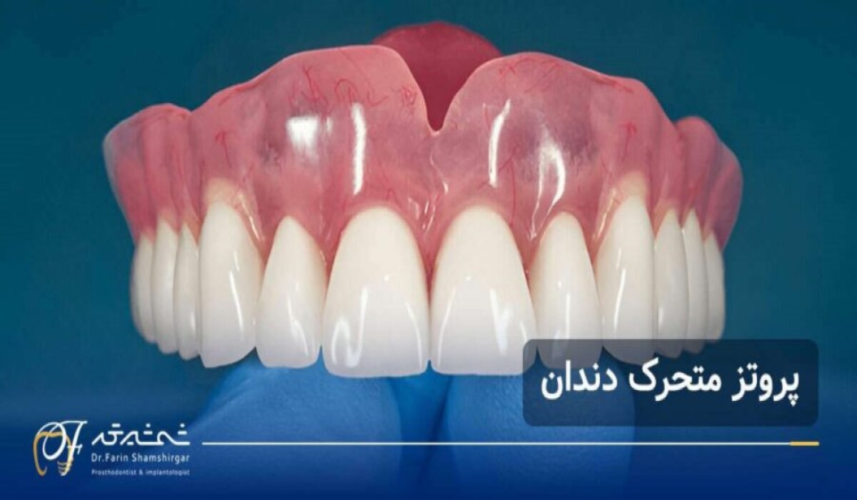 پروتز متحرک دندان