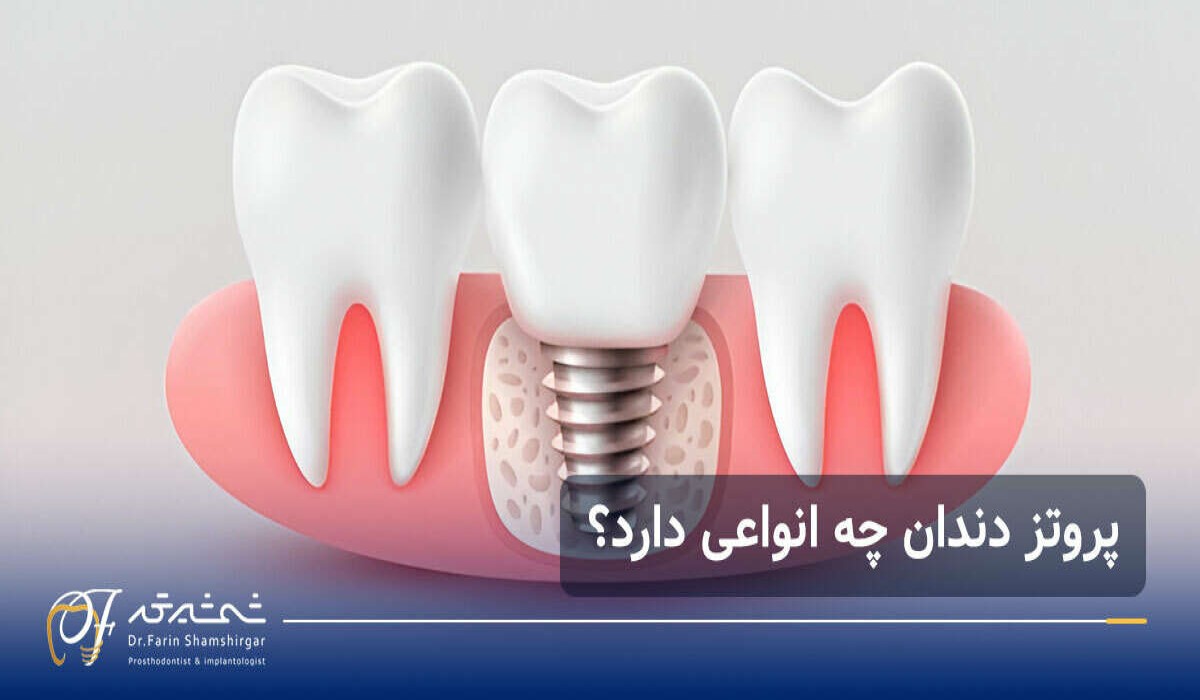انواع پروتز دندان