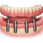 اوردنچر دندان چیست؟