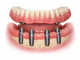 اوردنچر دندان چیست؟