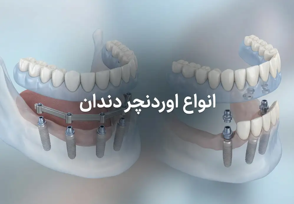 انواع اوردنچر