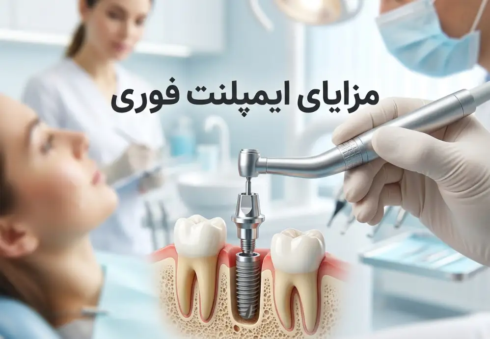 مزایای ایمپلنت فوری