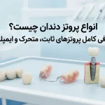 انواع پروتز دندان چیست