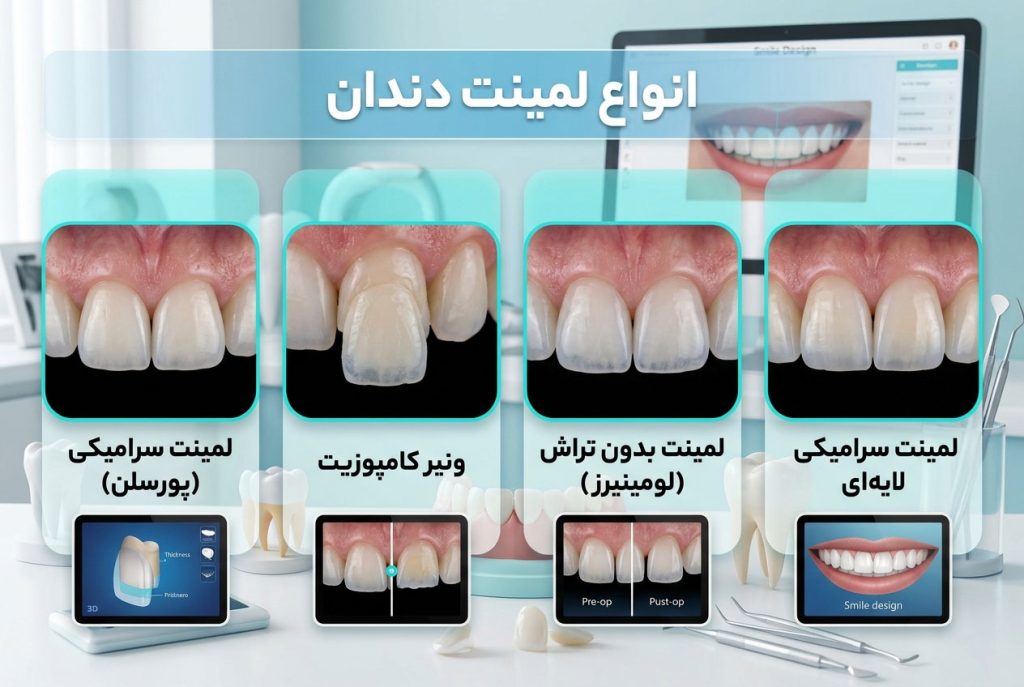 انواع لمینت دندان