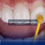 مزایا و معایب لمینت دندان