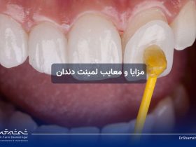 مزایا و معایب لمینت دندان