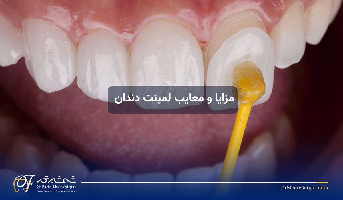 مزایا و معایب لمینت دندان