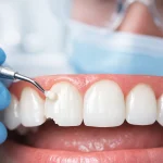 کامپوزیت دندان چیست