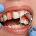 عوارض و مشکلات ایمپلنت دندان