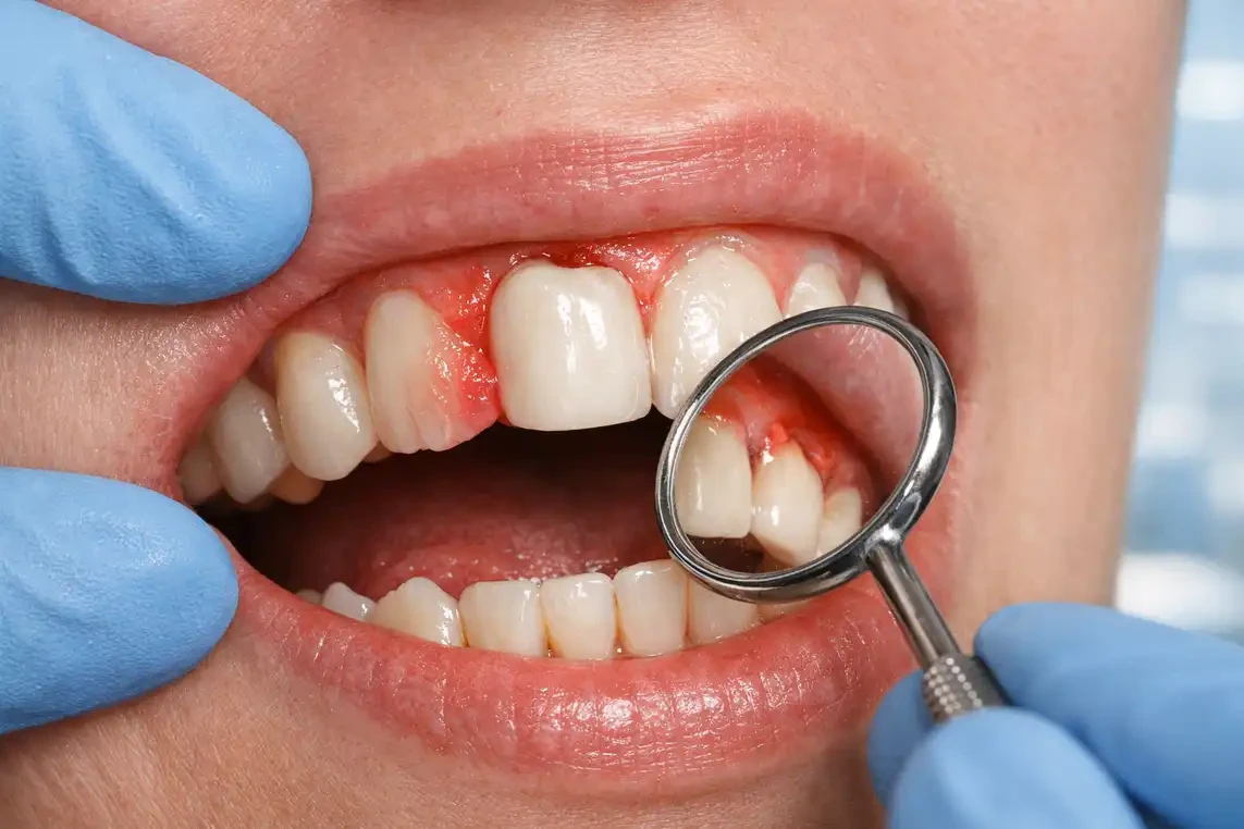 عوارض و مشکلات ایمپلنت دندان