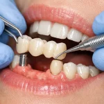 پروتز ثابت دندان چیست