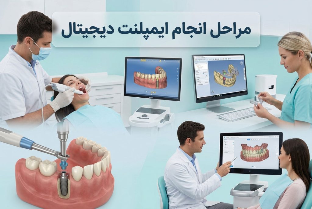 مراحل انجام ایمپلنت دیجیتال