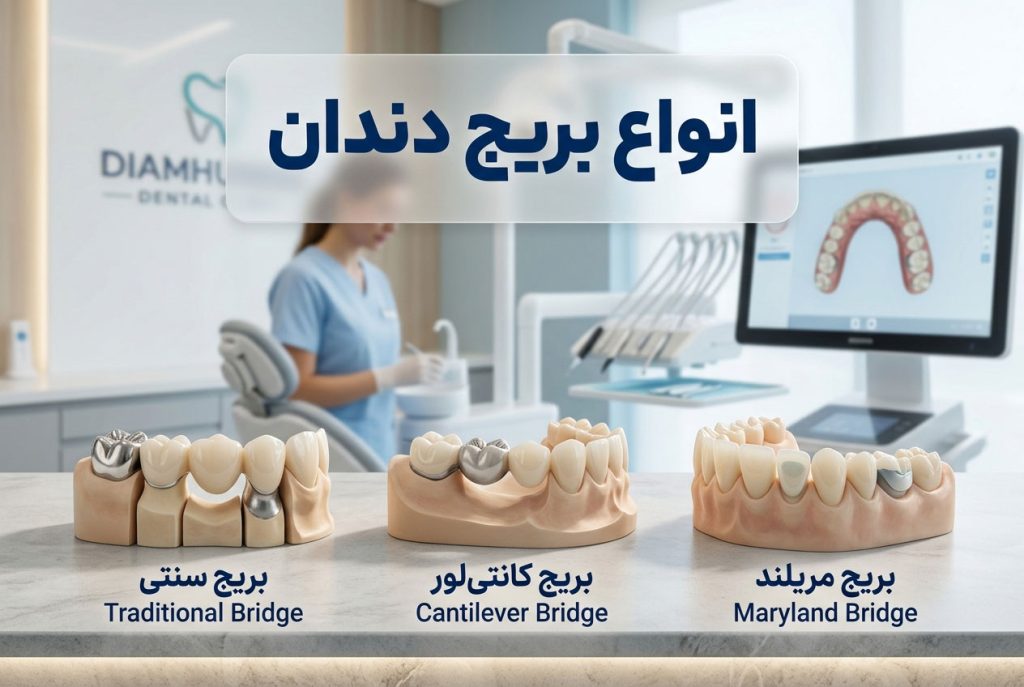 انواع بریج دندان