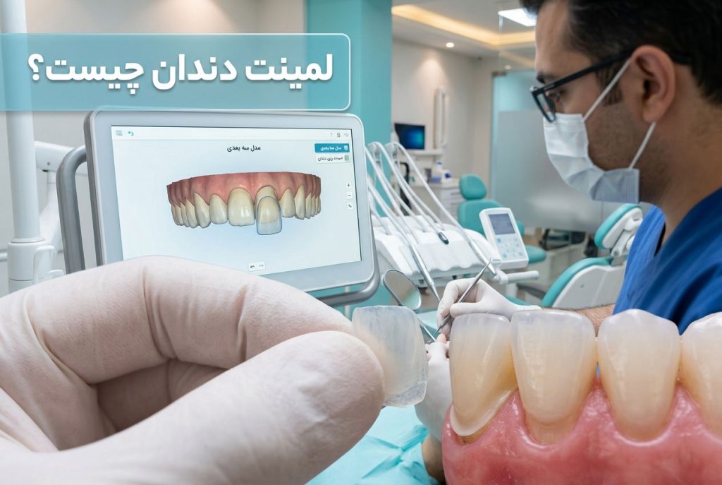 لمینت دندان چیست؟