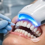 بلیچینگ دندان چیست