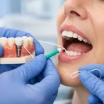 مراقبت بعد از ایمپلنت دندان