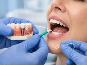 مراقبت بعد از ایمپلنت دندان