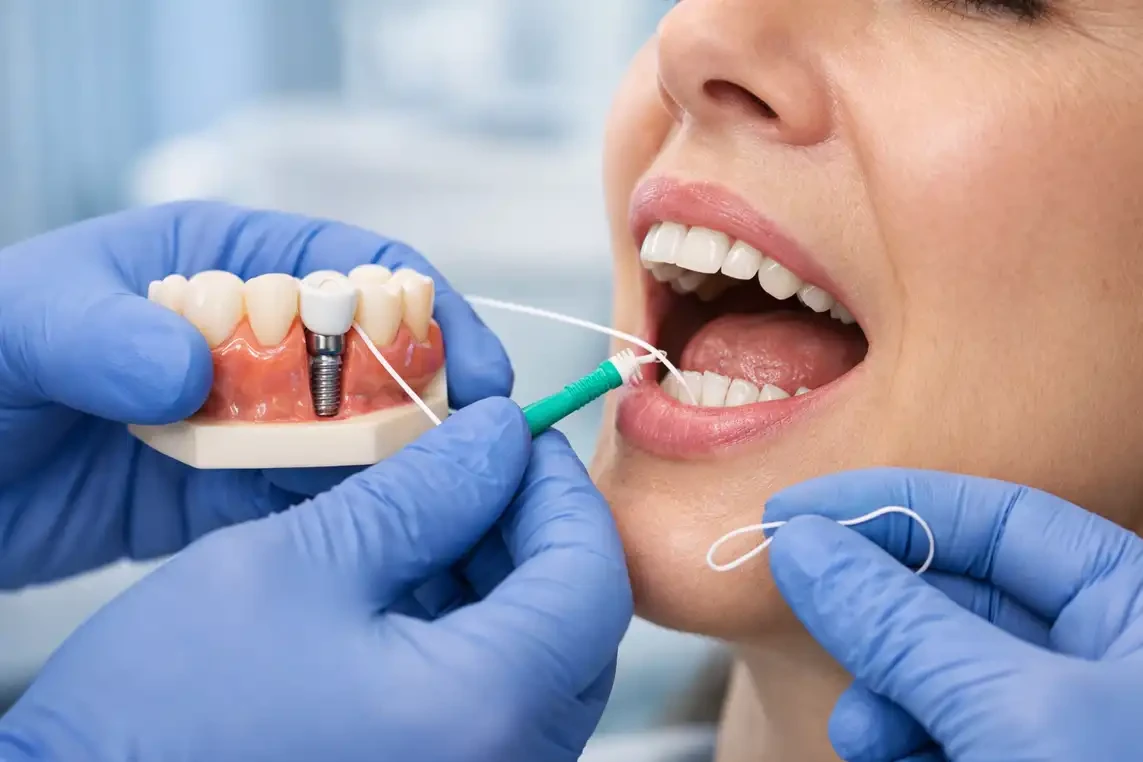 مراقبت بعد از ایمپلنت دندان