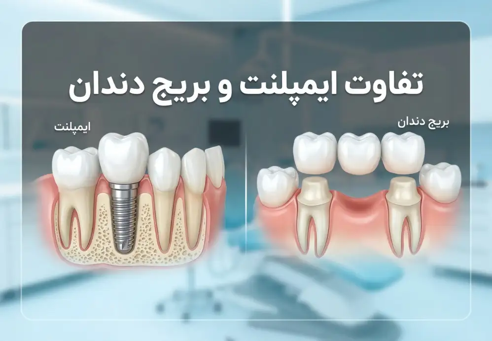 تفاوت ایمپلنت و بریج دندان