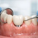 علائم عفونت ایمپلنت دندان