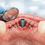 بخیه ایمپلنت دندان چیست