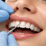 بستن فاصله بین دندان‌ها
