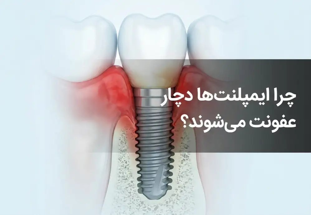 چرا ایمپلنت‌ها دچار عفونت می‌شوند؟