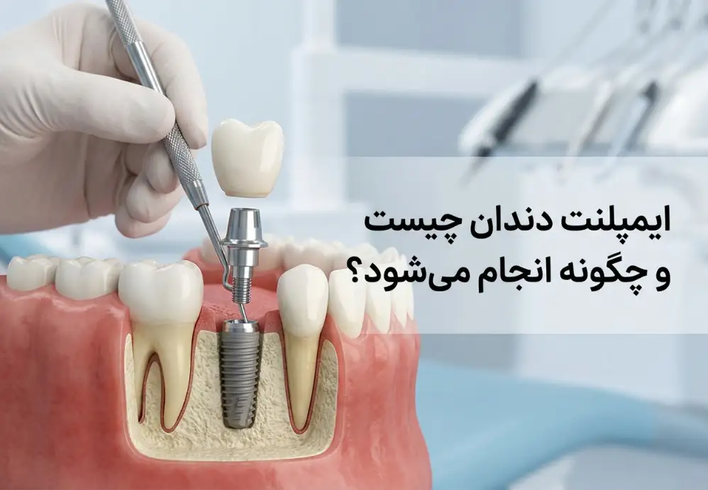 ایمپلنت دندان چیست و چگونه انجام می‌شود؟