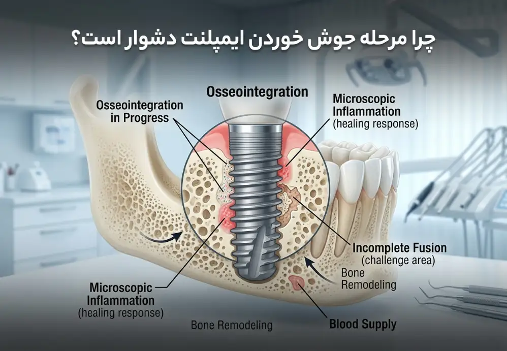 چرا مرحله جوش خوردن ایمپلنت دشوار است؟