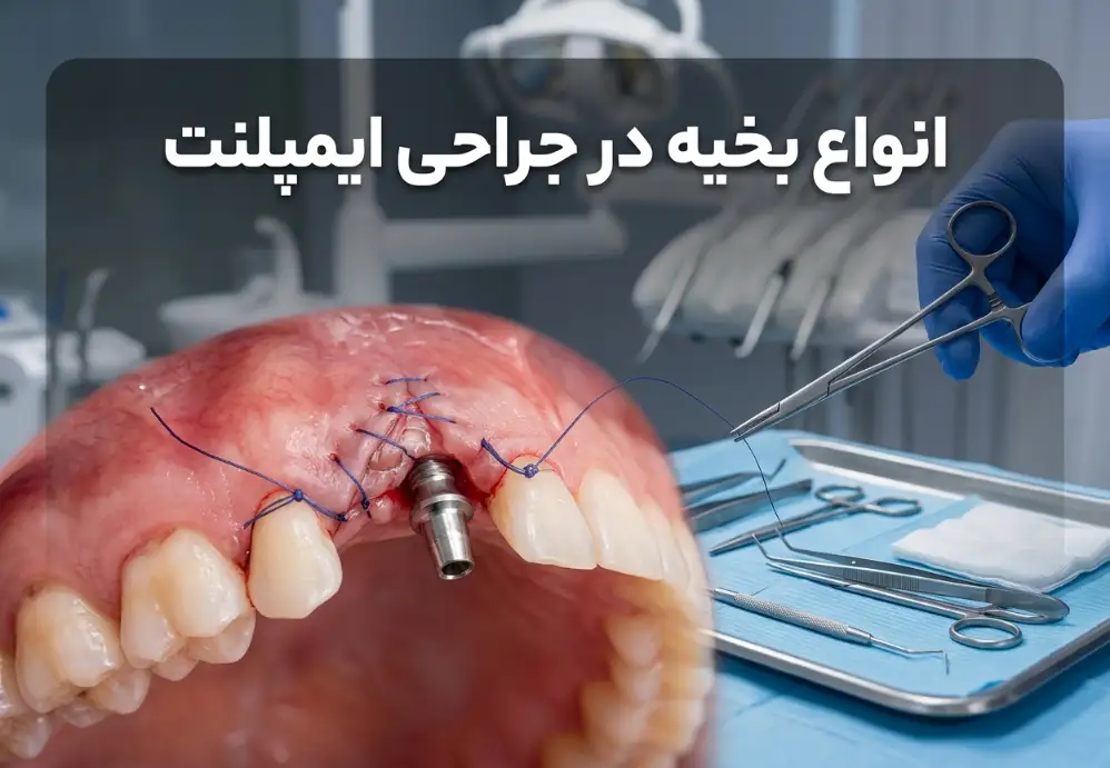 انواع بخیه در جراحی ایمپلنت