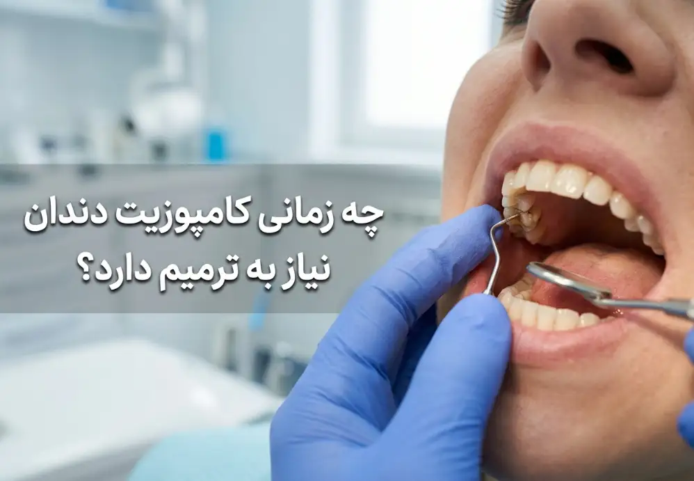چه زمانی کامپوزیت دندان نیاز به ترمیم دارد؟