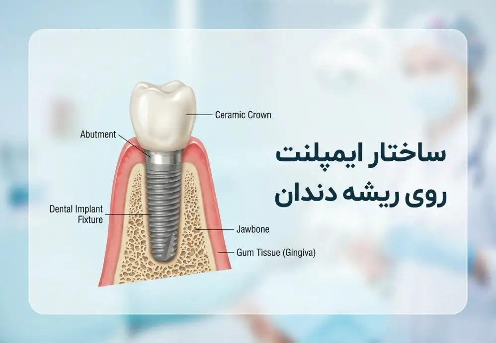 ساختار ایمپلنت روی ریشه دندان