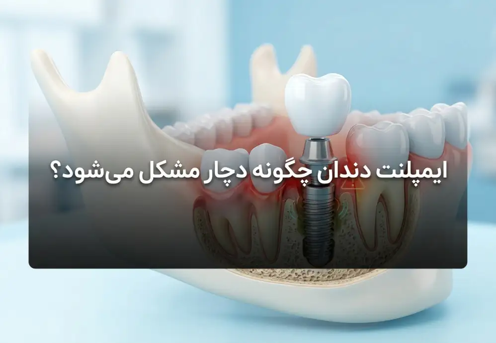 ایمپلنت دندان چگونه دچار مشکل می‌شود؟