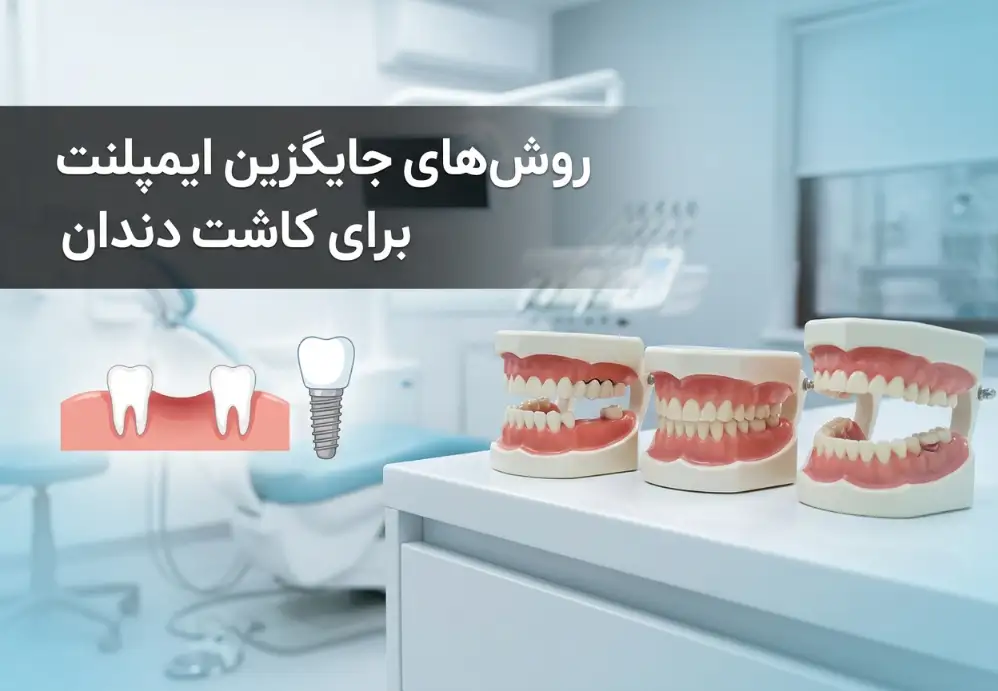 روش‌های جایگزین ایمپلنت برای کاشت دندان