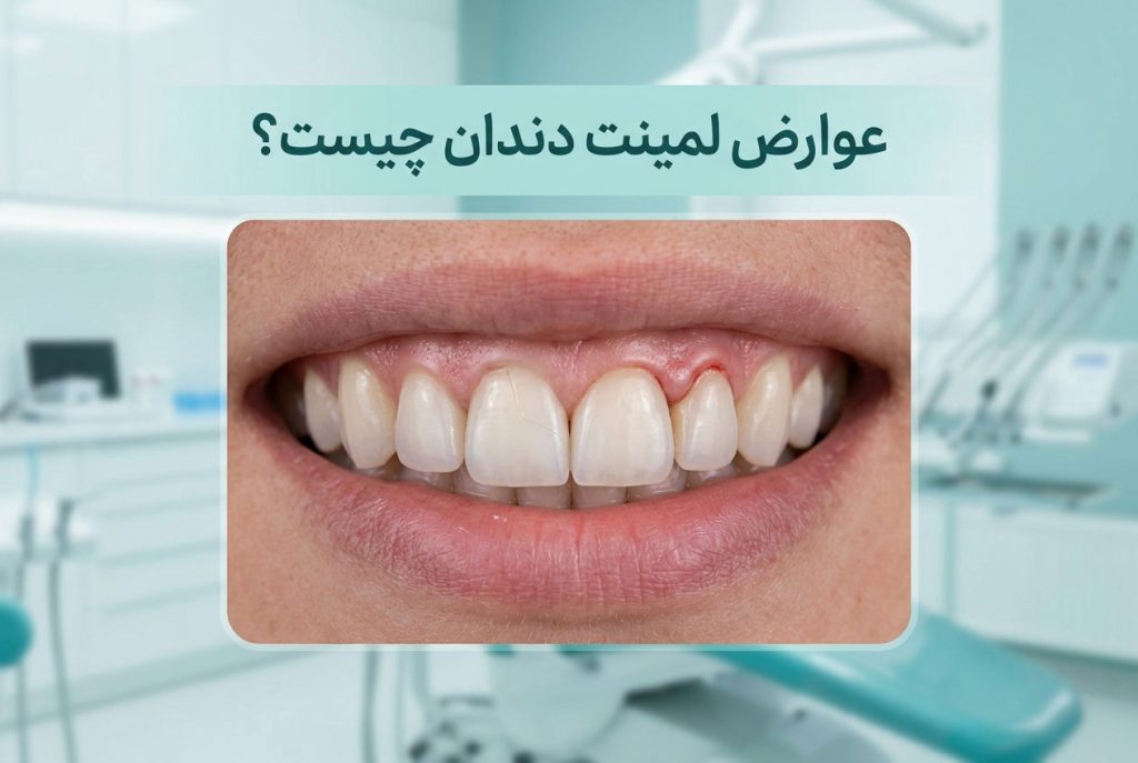 عوارض لمینت دندان چیست؟