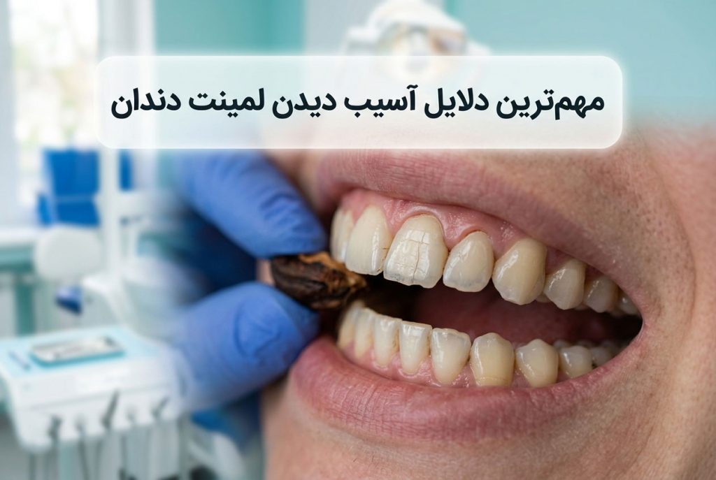 مهم‌ترین دلایل آسیب دیدن لمینت دندان