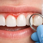 عوارض لمینت دندان چیست