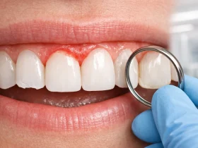 عوارض لمینت دندان چیست