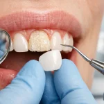 دلیل افتادن لمینت دندان چیست