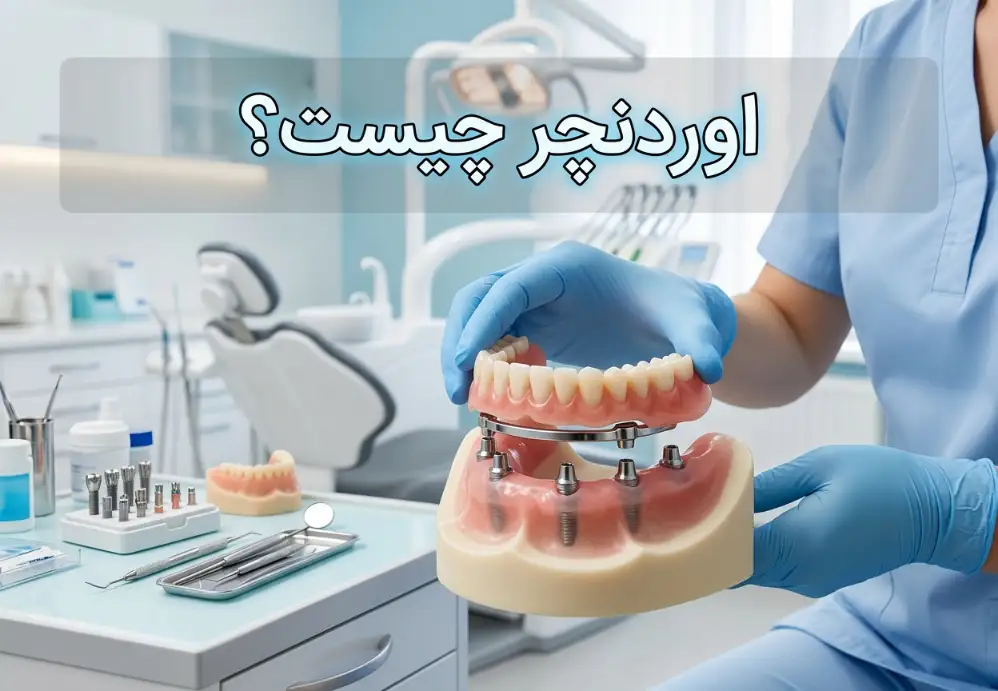 اوردنچر چیست؟