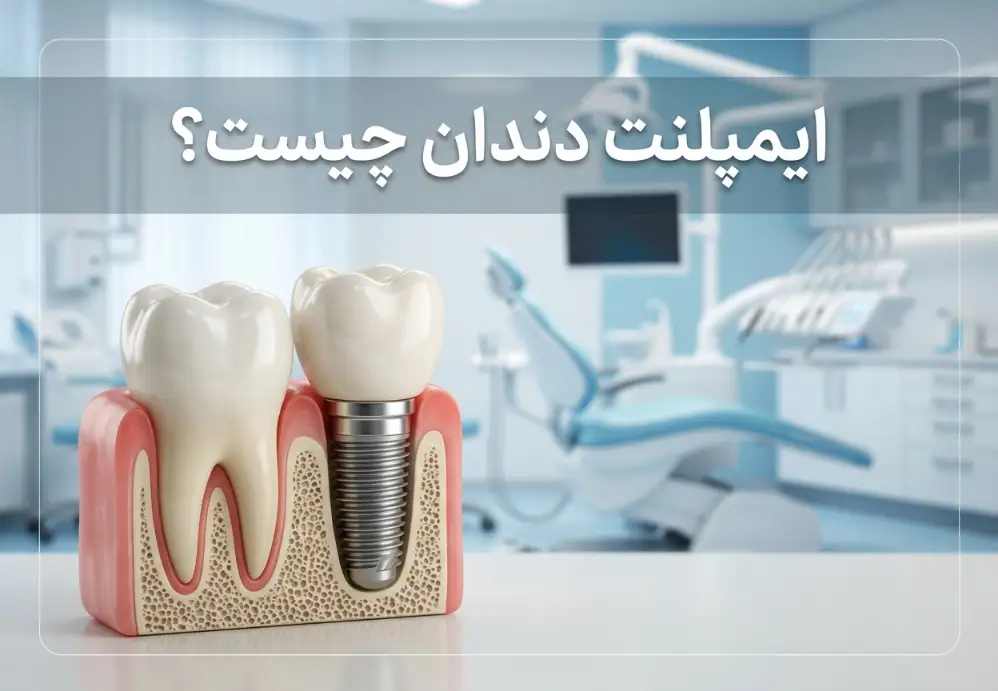 ایمپلنت دندان چیست؟