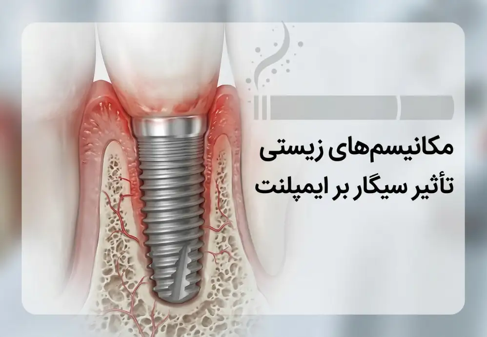 مکانیسم‌های زیستی تأثیر سیگار بر ایمپلنت