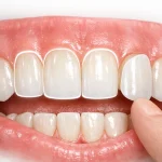 هر واحد لمینت چند دندان است