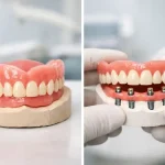 تفاوت اوردنچر با دندان مصنوعی