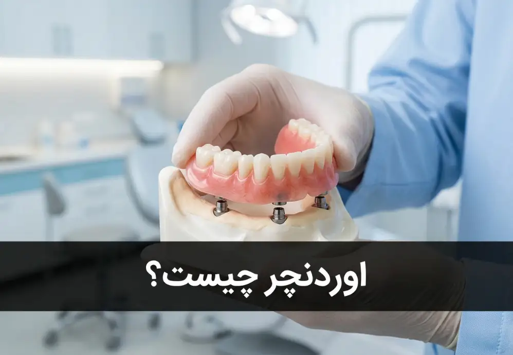 اوردنچر چیست؟