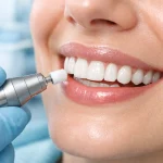چگونه کامپوزیت دندان را سفید کنیم