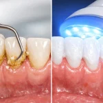 تفاوت جرم‌گیری دندان با بلیچینگ چیست