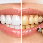 تأثیر سیگار بر لمینت دندان