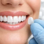 بهترین ونیر دندان چیست